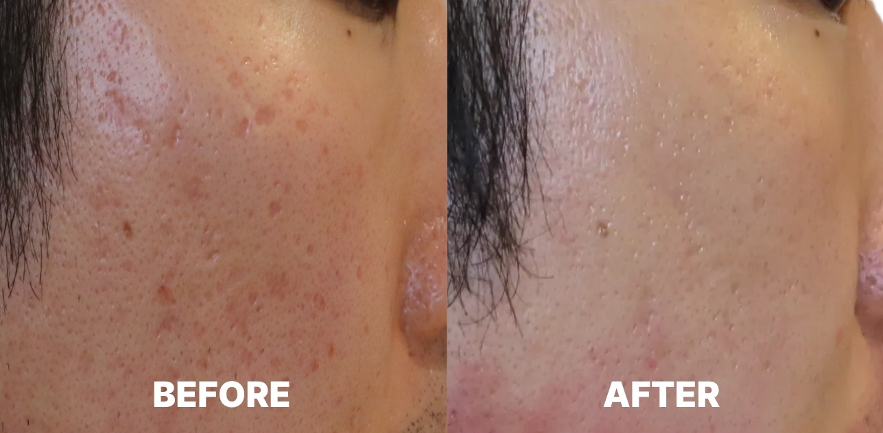 Acne Scar Treatment: Before & After