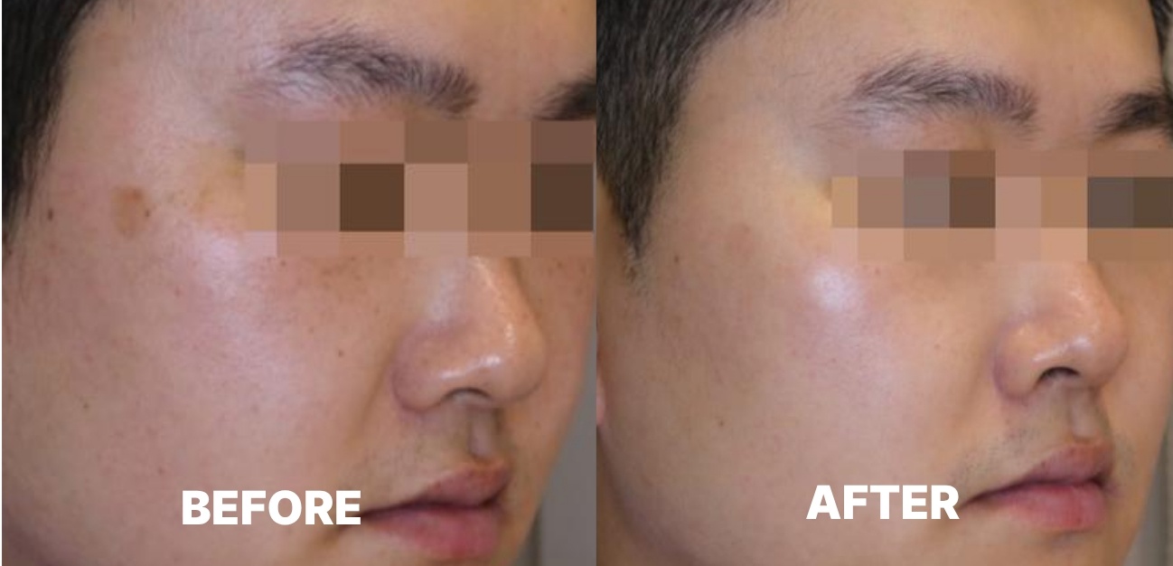 Pigmentation Treatment: Before & After