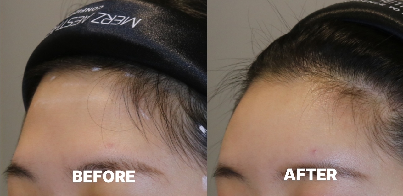 Forehead Filler: Before & After